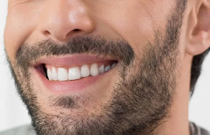 Beard and mustache transplant