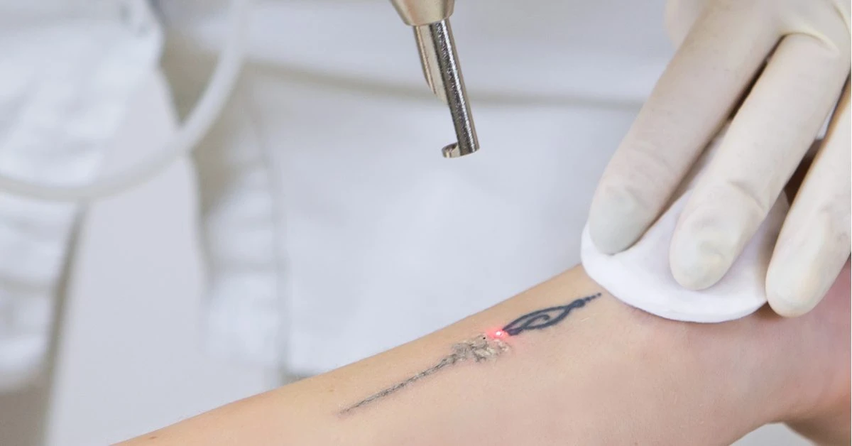 Tattoo and pigmentation removal