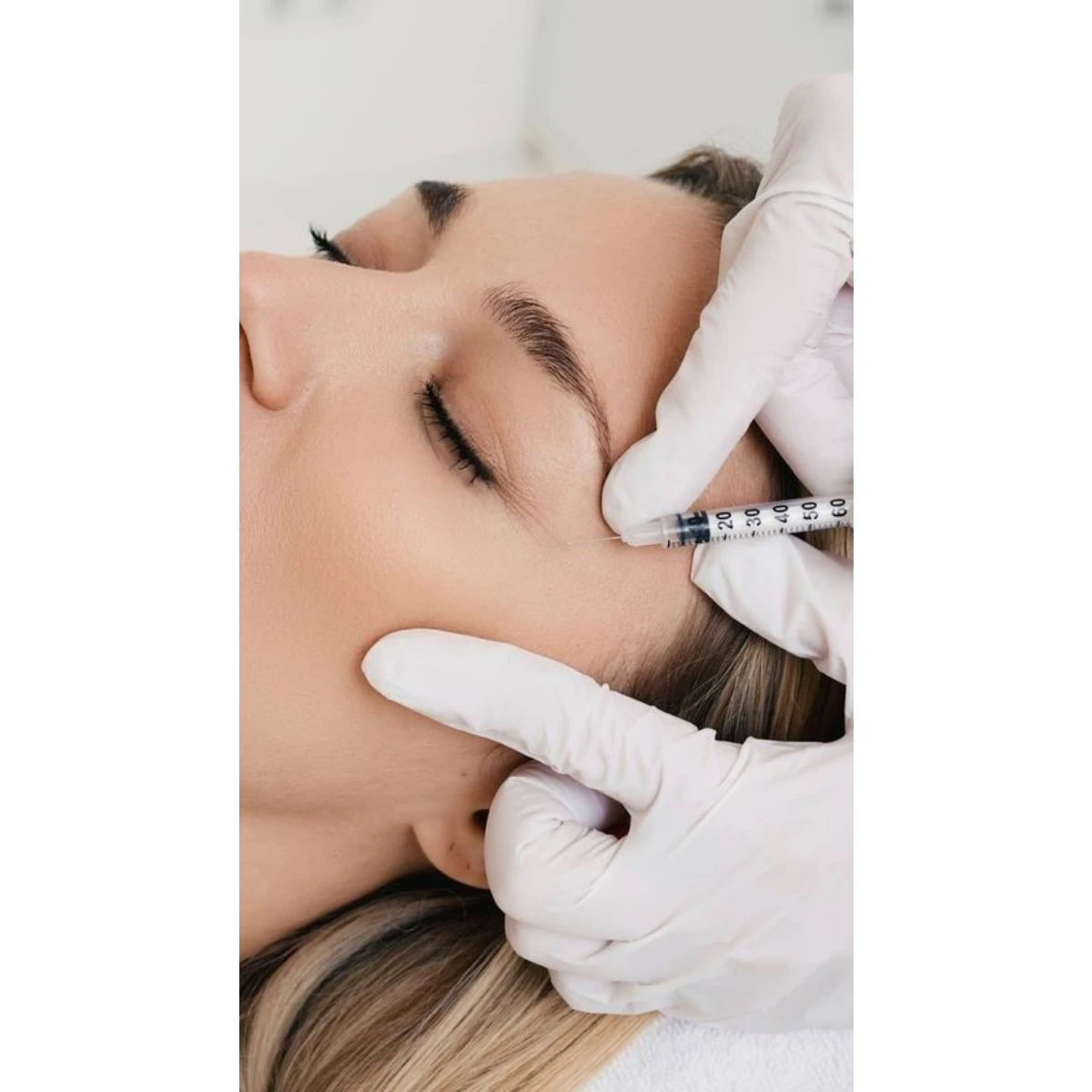 Botox 50 units (forehead and around the eyes)